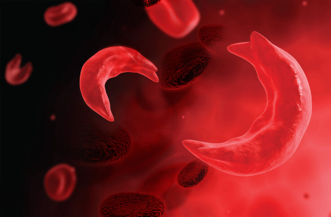 African pharma are building an homegrown response to sickle cell disease